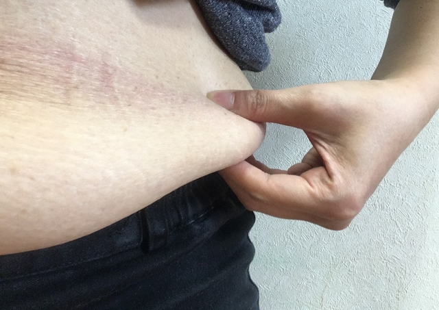 肥満による死亡リスクは、本当はもっと高いかもしれない