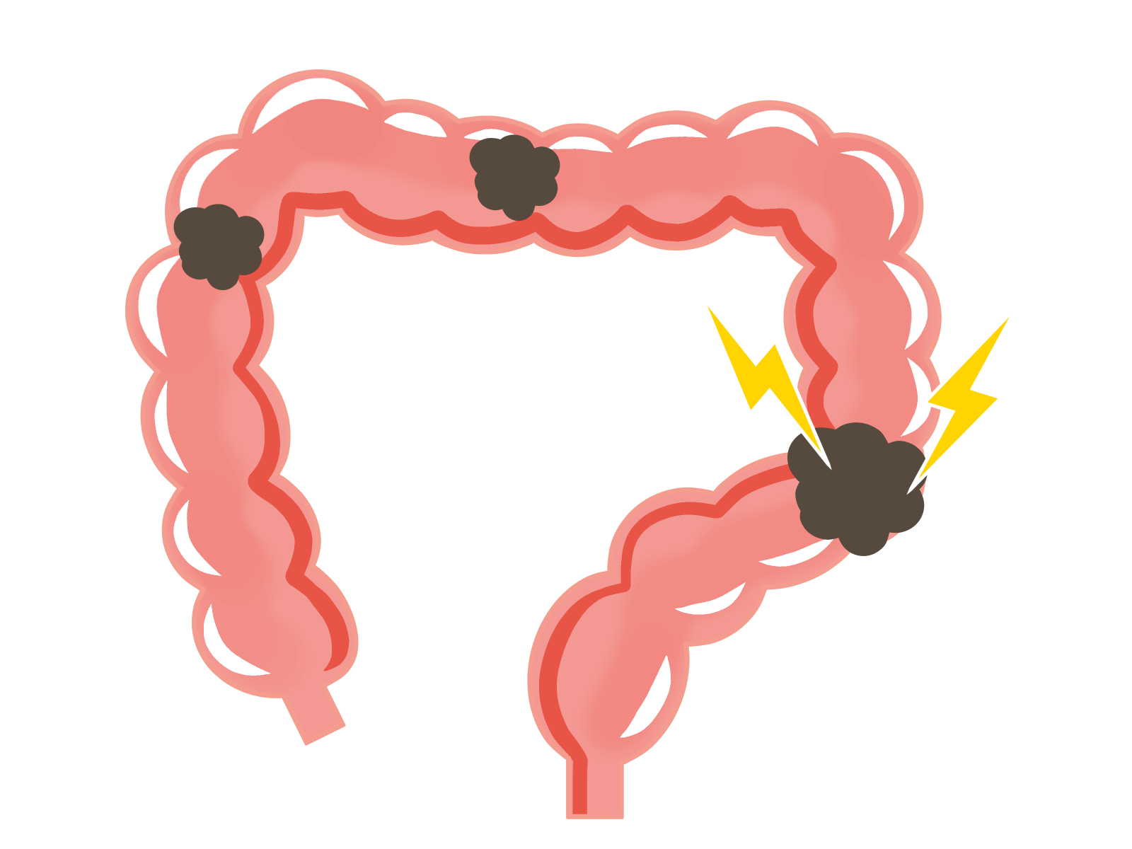 コレステロールの低下は大腸がんのリスクを増加させるかもしれない