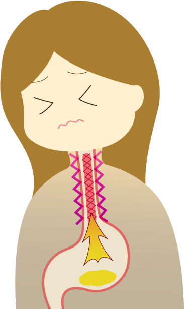 PPI（プロトンポンプ阻害薬）は食道がんのリスクを高める