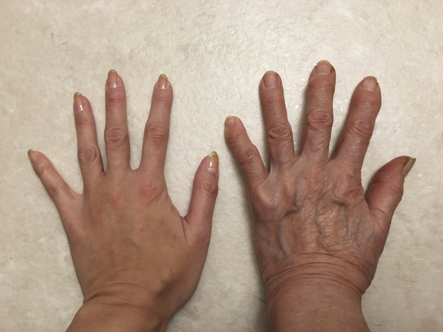 人により45歳ですでに老化スピードに差が出ている