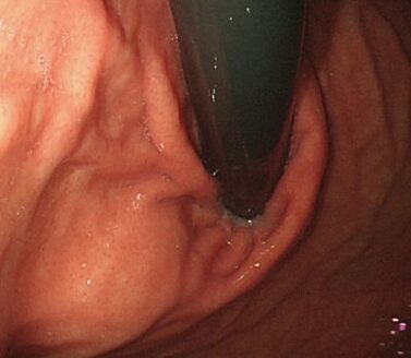 ウイルスや細菌が原因と考えられているがんは本当にウイルスや細菌のせいなのか？　その1　ヘリコバクター・ピロリ
