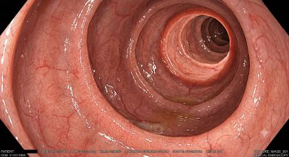 若年性のがんの発生率は世界的に増加している　その2　コリバクチン産生大腸菌犯人説